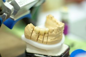 What Are Digital Dentures? Revolutionizing the Future of Dental Care